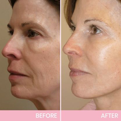 InvisiLift™ | Invisible Adhesive Tape for Facial Lifting