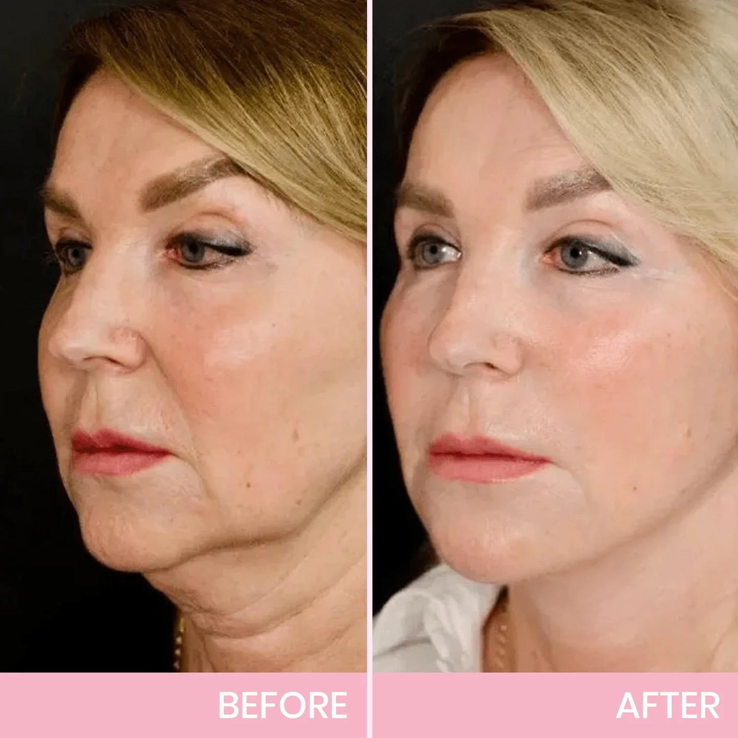 InvisiLift™ | Invisible Adhesive Tape for Facial Lifting